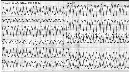 兄弟俩都发生了室速,一个在左,一个在右 为老爷