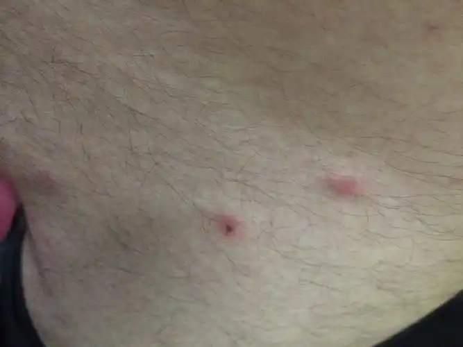 被蟑螂咬了会有什么样的特征?