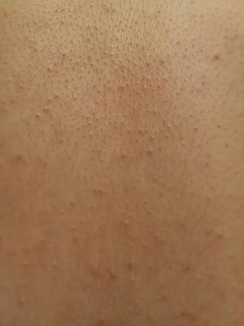 有姐妹背上长密密麻麻的小颗粒吗?