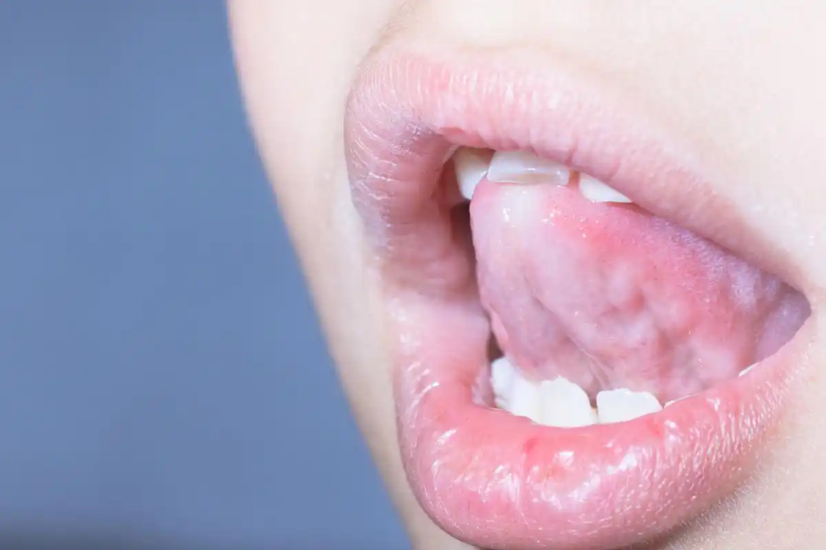 舌下血管发紫,到底怎么回事?一篇文章告诉你.