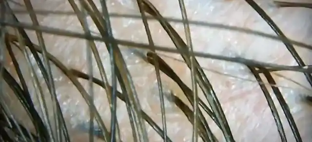 毛囊萎缩,闭合就再也长不出头发了.怎么样才算毛囊萎缩呢?