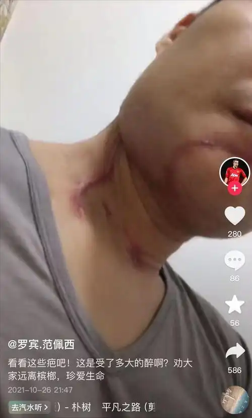 这次手术也让他痛改前非把烟酒槟榔都戒了,之后也是经常发自己的伤口