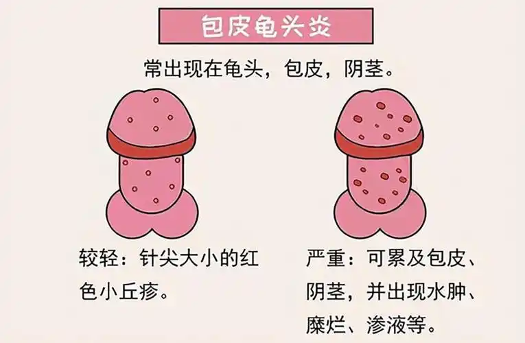 3,包皮龟头炎皮脂腺的分泌会受到雄激素的影响,雄激素可以使皮脂腺的