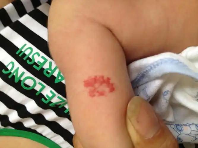 你好,宝宝两个月,手臂上长了一块红色的斑点,不知道是什么?