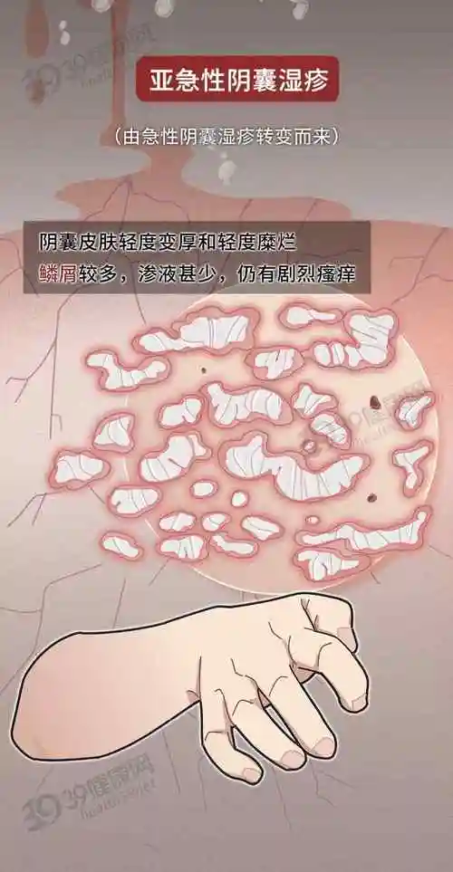 为什么脖子湿疹阴囊湿疹