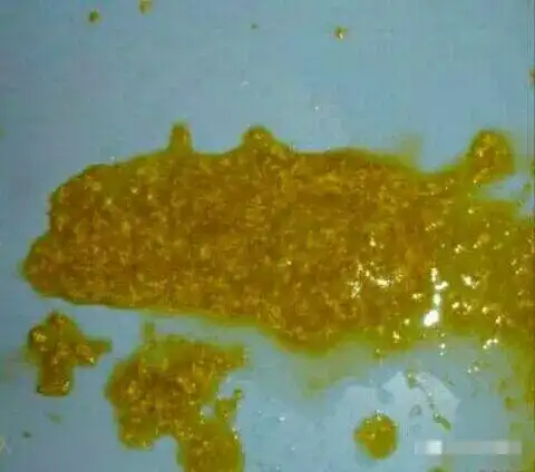 3.蛋花汤样大便