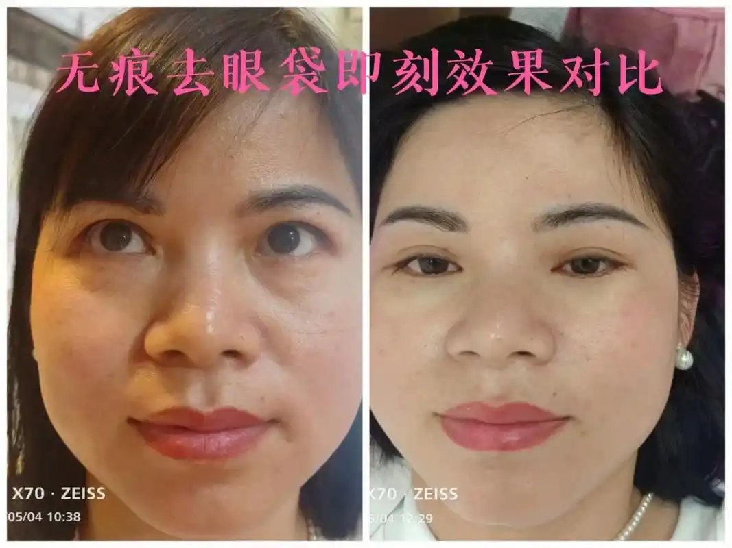 眼袋泪沟09  一旦有了眼袋 千万不要以为 靠涂涂抹抹 就能 - 抖音