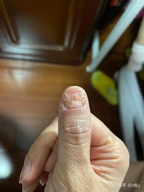 指甲被车门夹,恢复记录 - 知乎