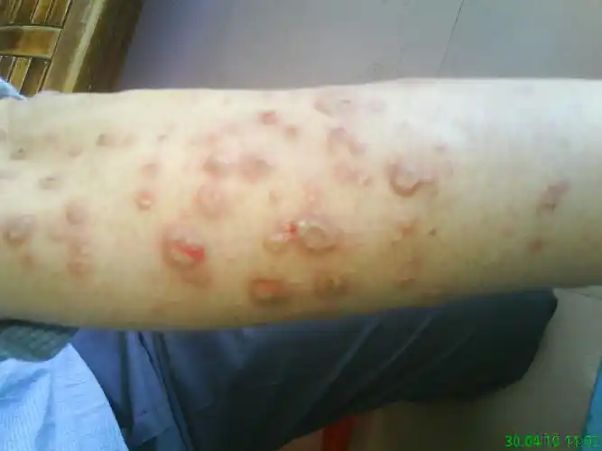 今天看到的一皮肤病人(照片模糊—虫版注)
