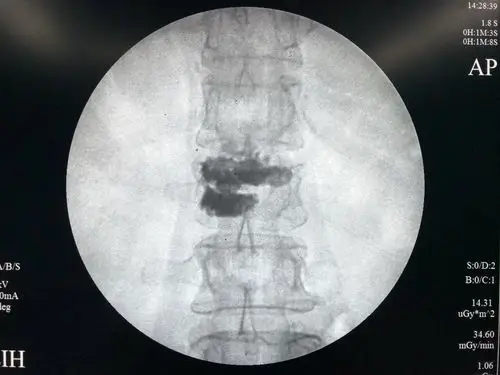骨质疏松性椎体压缩性骨折的微创治疗 - 好大夫在线