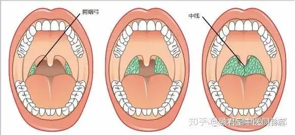 【颐君堂:分享】扁桃体肿大的三度划分