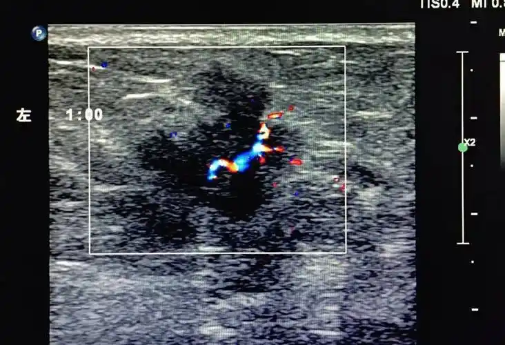 关于乳腺癌你了解多少