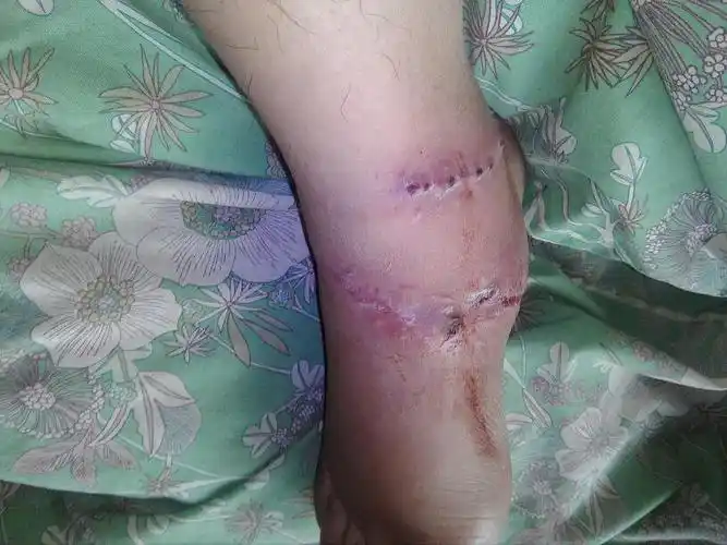 脚筋断了手术后一个月了,踝关节不能像正常那样弯曲正常