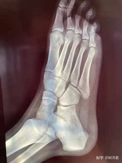 第五跖骨基底部裂纹骨折忧伤记录