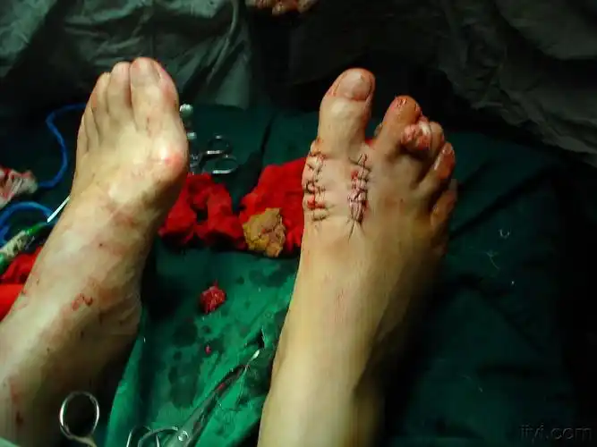 女性双足拇趾外翻治疗方法探讨