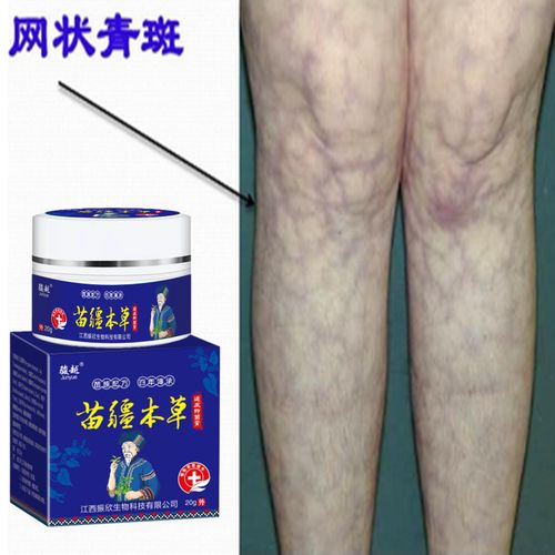 网状青斑皮疹破溃红肿发热疼痛流脓静脉扩张麻木红斑狼疮外用药膏