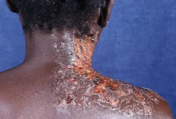 艾滋病皮肤会痒吗