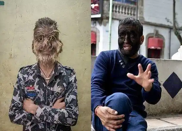 这个世界有着各种各样奇怪的疾病,有一种奇怪的疾病叫做狼人综合症,也