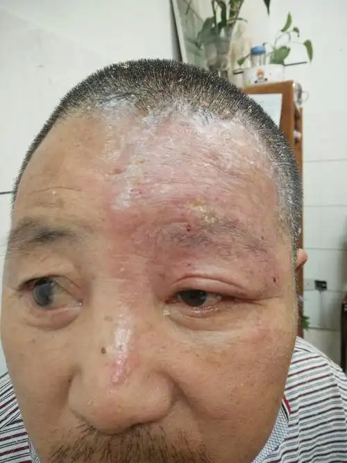 眼睑带状疱疹及引起的病毒性角膜炎的经验治疗_带状疱疹_介绍_治疗