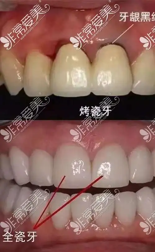 我做过两个全瓷牙和一个烤瓷牙,全瓷牙用了三年没啥事,烤瓷牙用着里面