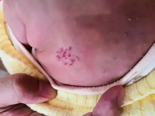 宝宝背上长了血管瘤