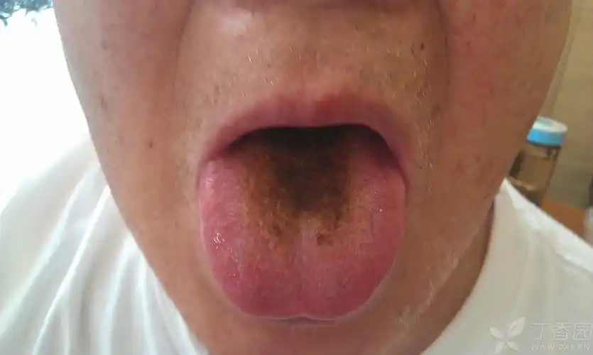 【原创】一个舌苔变黑病例