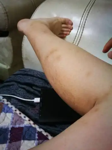 请问女生手上腿上有疤可以当兵吗都在右腿右手上烫伤的腿上一小块是