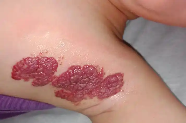 樱桃状血管瘤图