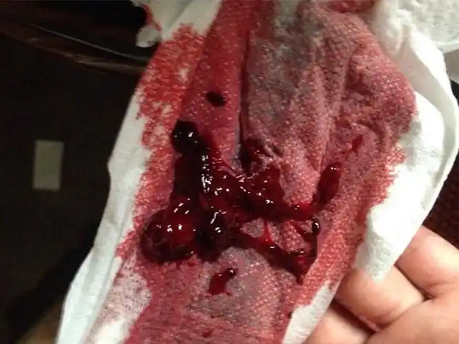 子宫内膜整个脱落是什么样的?有真正的图片吗?