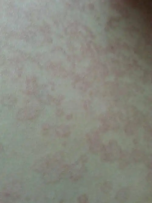 我的胸部出现淡红斑不痛不痒,会扩散已有七八个月了