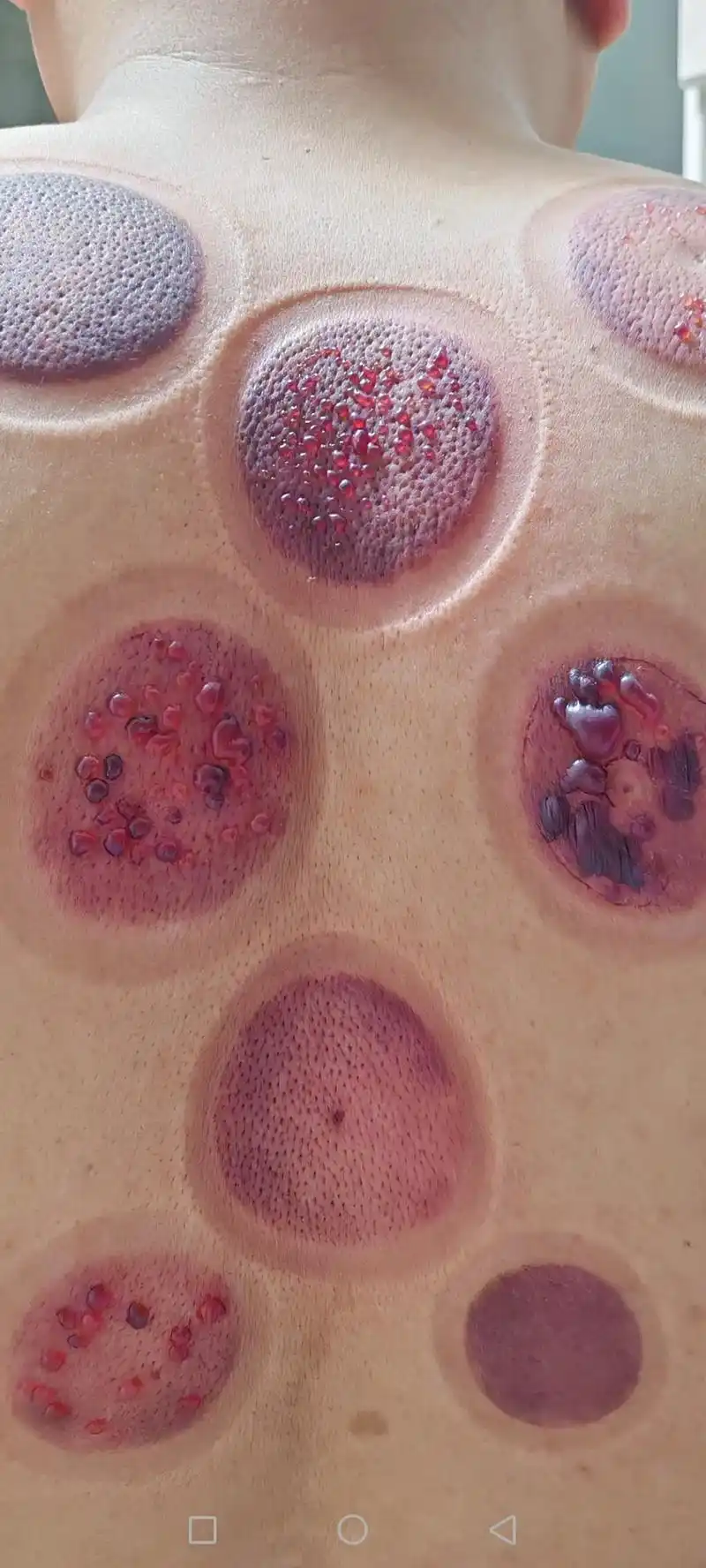 干的一后背水葫芦!#拔罐养生 - 抖音