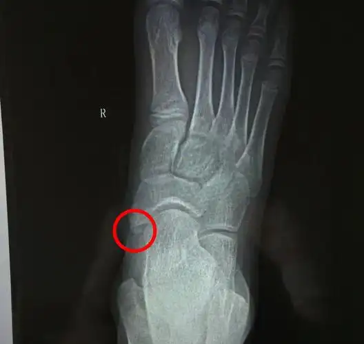 儿童足部副舟骨的治疗_先天性足畸形_先天性足畸形治疗方式 - 好大夫