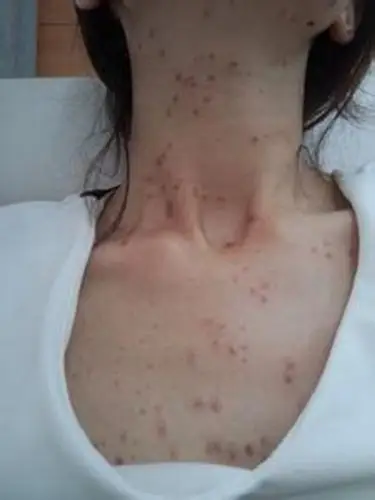 脖子周围长扁平疣图片