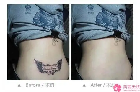 东莞市激光手术去除纹身哪个医院好(东莞市激光手术去除纹身医院在榜