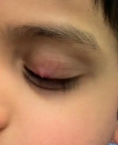 眼皮上长了个疙瘩图片 (13)_有来医生