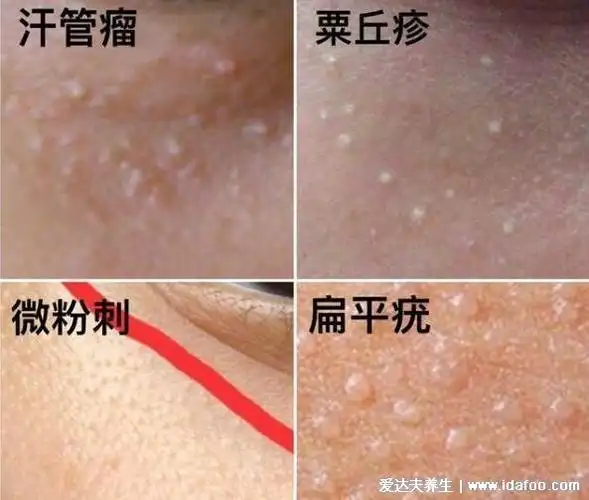 眼部扁平疣图片及去除方法,不痛不痒有传染性的粉色疙瘩