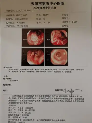 肠癌病例汇报 写美篇  患者 刘乃生 男 73岁,bmi  21 主因间断大便带