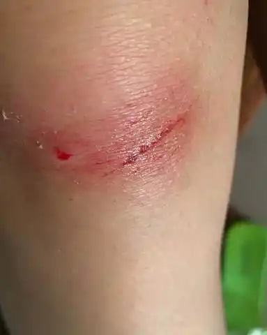 今天出门不小心摔了一跤,手脚被擦破皮了而已会不会对胎儿有有危险?