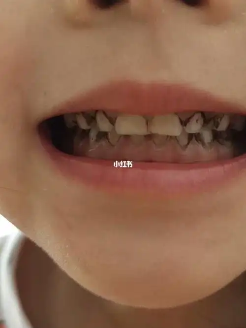 宝宝的牙菌斑日记