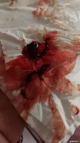 [试管婴儿]移植22天.出血.谁明白.怎么