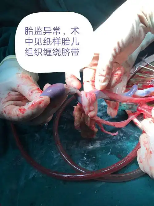 其它 脐带的异常表现 写美篇正常脐带血管是一条静脉,两条动脉.