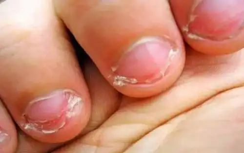 孩子吃手的危害竟然这么大