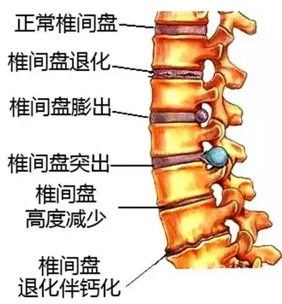 盘锦交感神经型颈椎病怎么办
