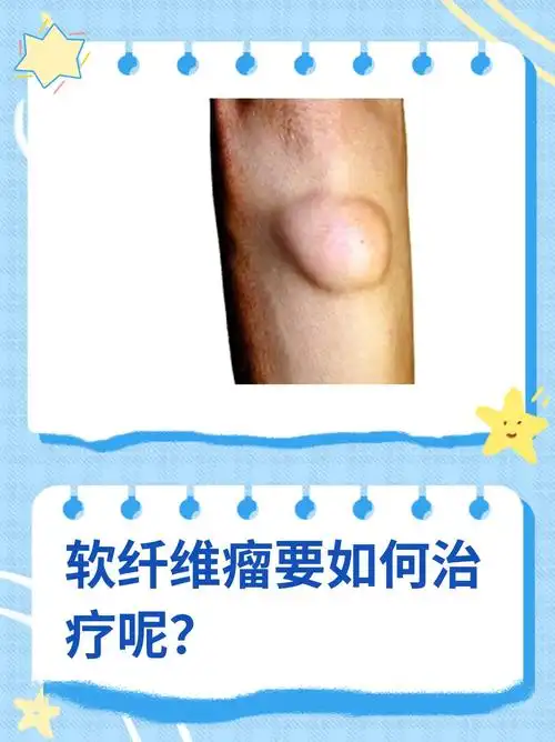 软纤维瘤要如何治疗呢