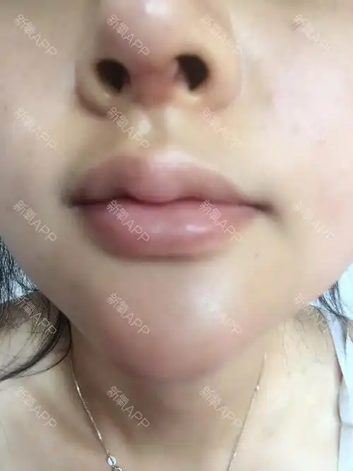 假体隆鼻鼻孔里张个硬疙瘩,白色的,在右鼻孔里,硬硬_圈子-新氧美容