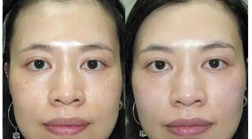 曙光祛晒斑的效果