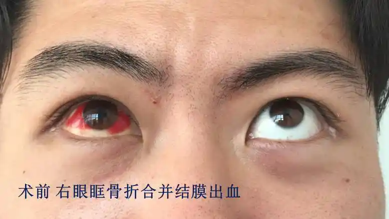 眼眶骨折术后眼白发黄发红多久能恢复?