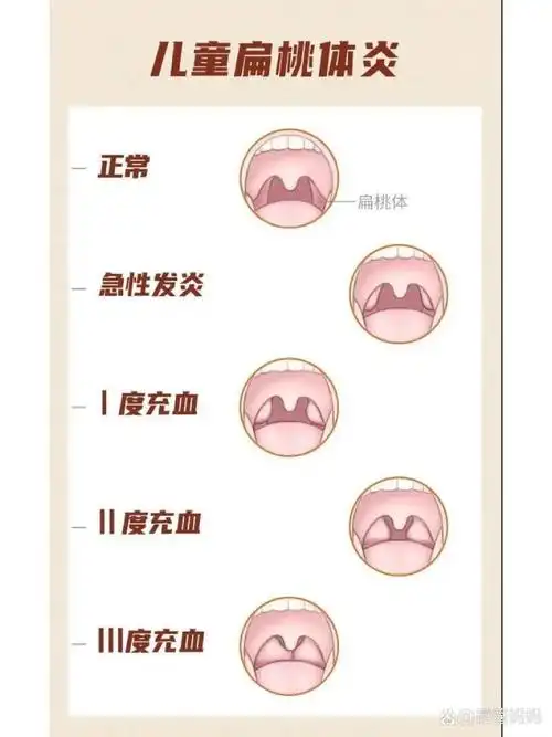 儿童扁桃体发炎分度  #扁桃体发炎按大小分为三度 一度肥大:不超过腭