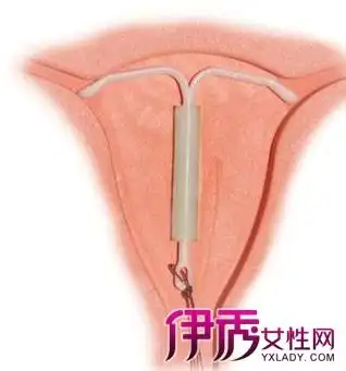 【图】女人带环有几种图片说明 揭秘女性上环全过程