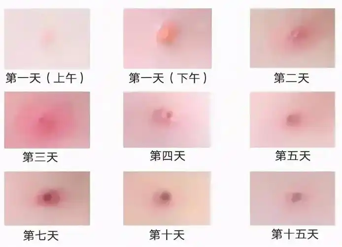 对水痘——带状疱疹病毒感染者主要是对症处理,目前无特效治疗方法